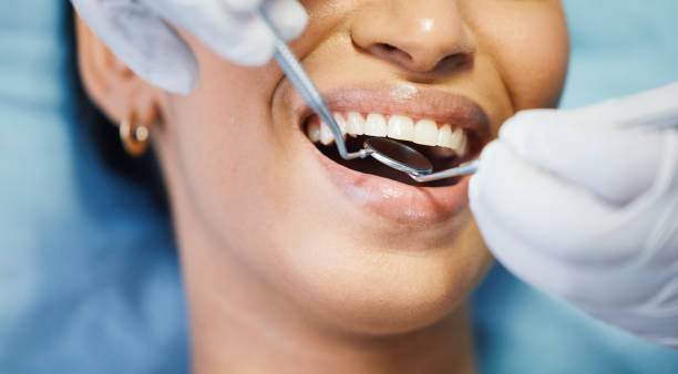 Best Emergency Wisdom Teeth Removal in Carolina Beach, NC